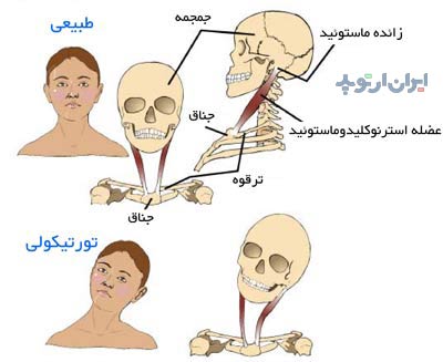 تورتیکولی یا کجی گردن