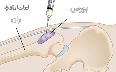 درمان بورسیت لگن با تزریق کورتون درون آن