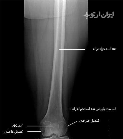  رادیوگرافی رخ قسمت های وسط و پایین ران