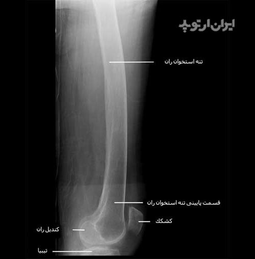  رادیوگرافی نیمرخ ران