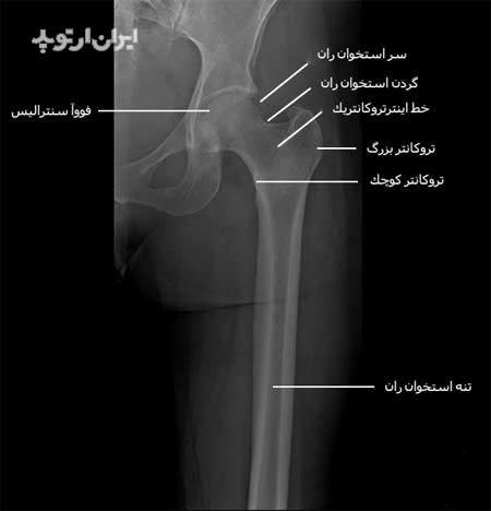  رادیوگرافی رخ قسمت های وسط و بالای ران