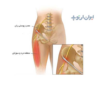 علائم بیماری مرالژی پارستتیکا چیست