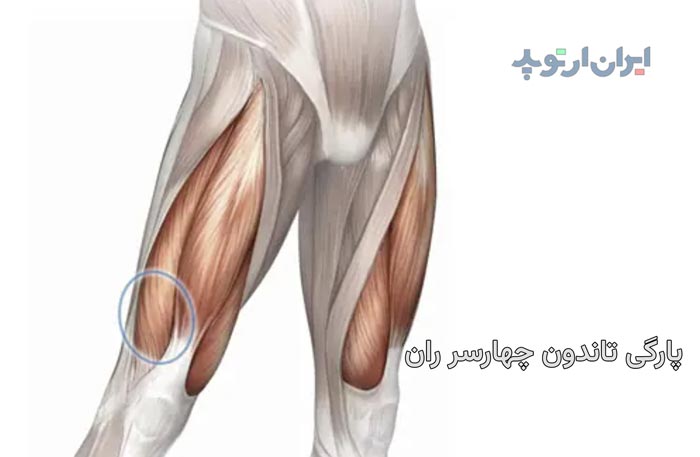 پارگی تاندون چهارسر ران چیست و چگونه درمان میشود