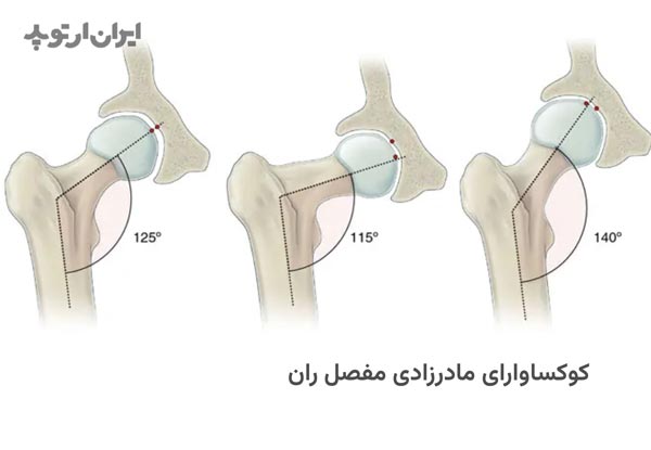 کوکسا وارا ی مادرزادی مفصل ران چیست