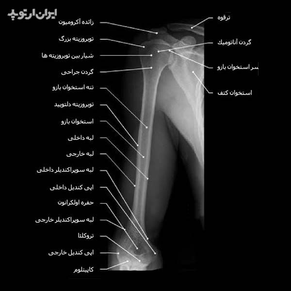 رادیوگرافی بازو