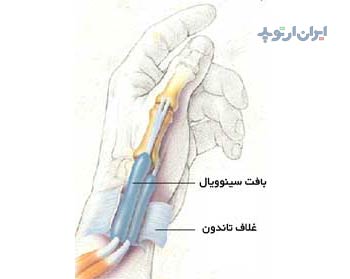 آناتومی تاندون های شست در بیماری دکرون