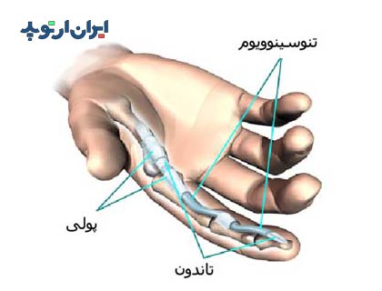 آناتومی دست. تاندون انگشت و غلاف آن