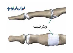 آناتومی دست. ولار پلیت انگشت دست