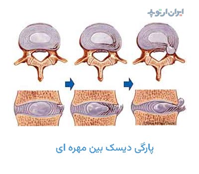 آناتومی ستون فقرات پارگی دیسک