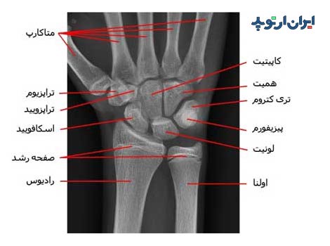 رادیوگرافی رخ مچ دست