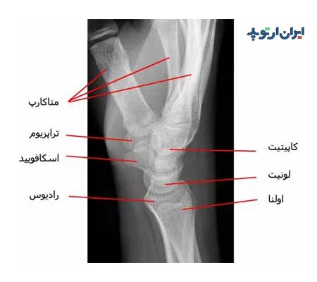 رادیوگرافی نیمرخ مچ دست