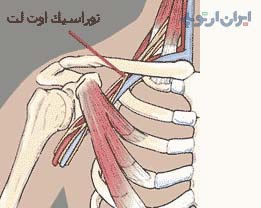 توراسیک اوتلت سندروم