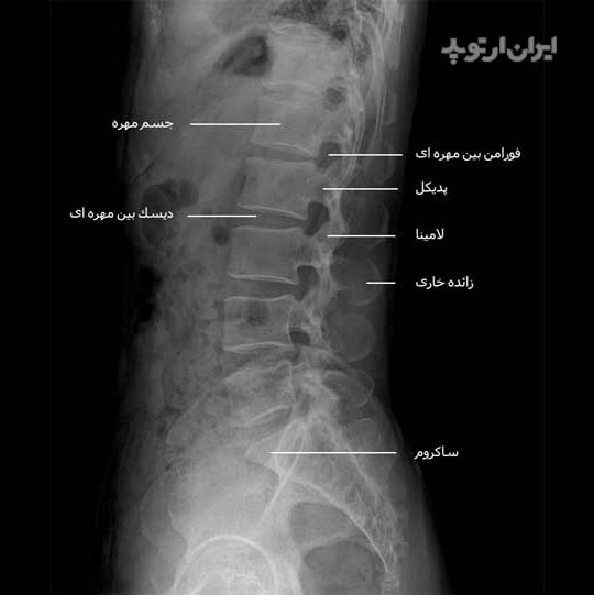 رادیوگرافی نیمرخ ستون مهره کمری