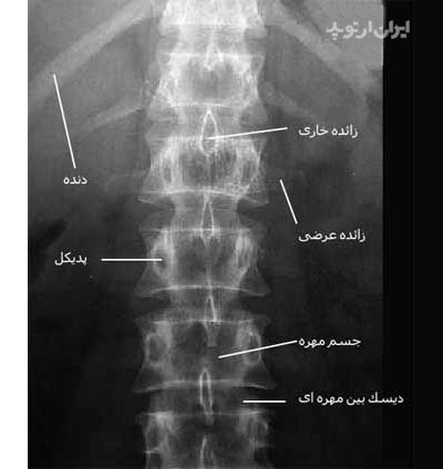 رادیوگرافی رخ ستون مهره کمری