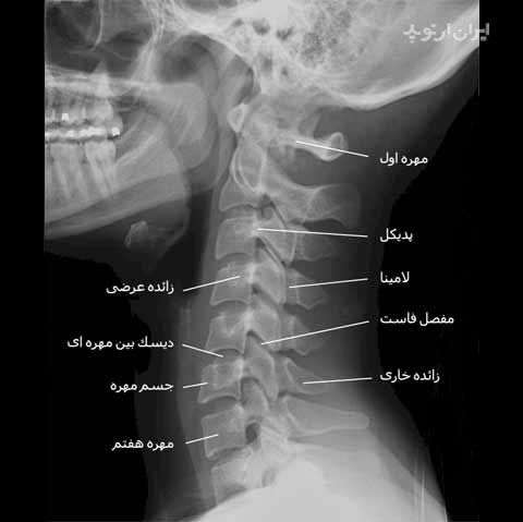 رادیوگرافی نیمرخ گردن