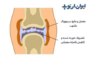 روماتیسم مفصلی یا آرتریت روماتوئید