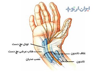 سندروم تونل کارپ