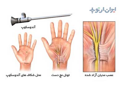 جراجی آندوسکوپیک سندروم تونل کارپال