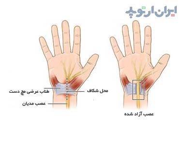 جراحی سندروم تونل کارپ