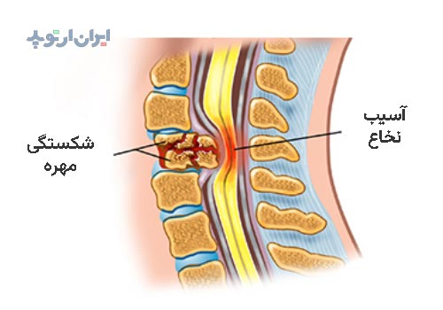 شکستگی ستون فقرات