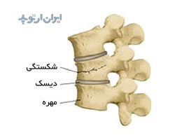 شکستگی مهره بعد از پوکی استخوان