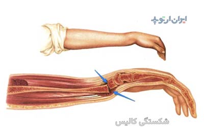 شایعترین نوع شکستگی مج دست شکستگی کالیس است