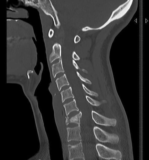 عکس شکستگی مهره گردن