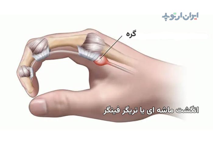 انگشت ماشه ای یا تریگر فینگر