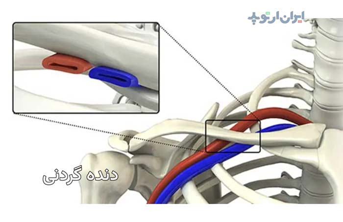 دنده گردنی