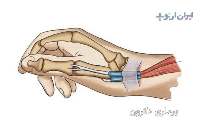 بیماری دکرون در مچ دست