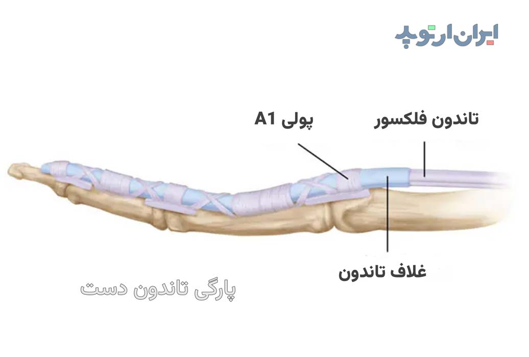 پارگی تاندون دست