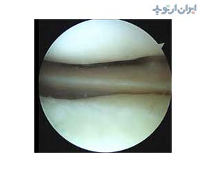 آناتومی زانو. آرتروسکوپی زانو منیسک