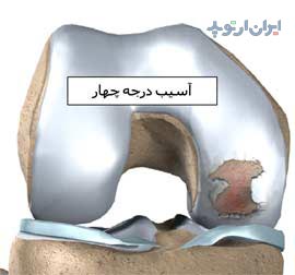 آسیب درجه چهار غضروف مفصل زانو