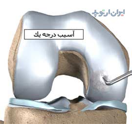 آسیب درجه یک غضروف مفصل زانو