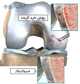 روش میکروفرکچر در درمان آسیب غضروف مفصل زانو