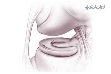 آناتومی زانو. آسیب منیسک