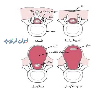 انواع اسپینا بیفیدا شامل مننگوسل و میلومننگوسل