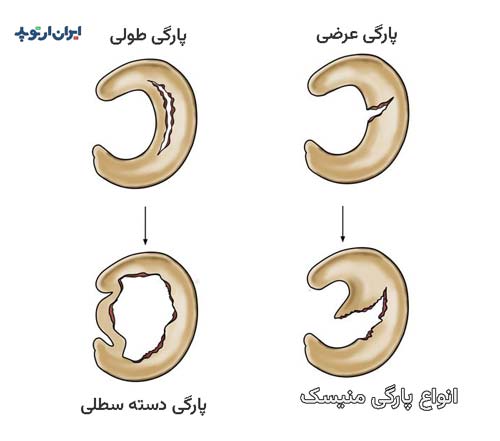 انواع پارگی منیسک زانو چیست