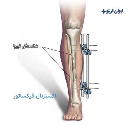 اکسترنال فیکساتور ساق پا