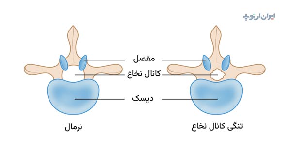 تنگی کانال نخاع کمری