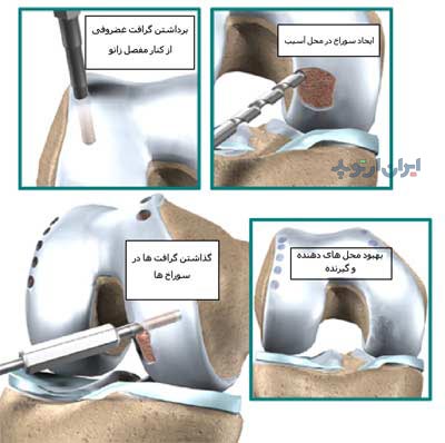 پیومد استخوانی غضروفی از خود شخص در درمان آسیب های غضروف مفصل زانو