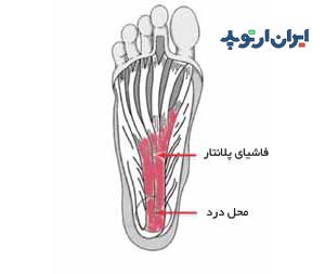 خار پاشنه و درد پاشنه پا