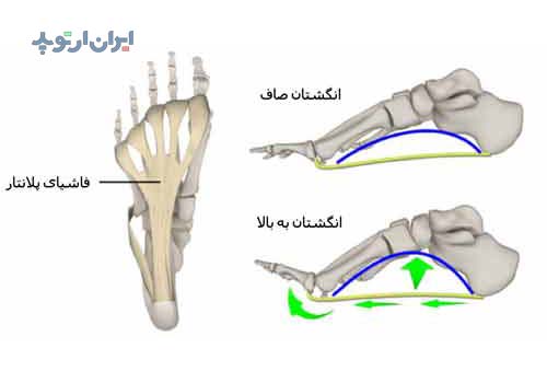 خار پاشنه و درد پاشنه پا