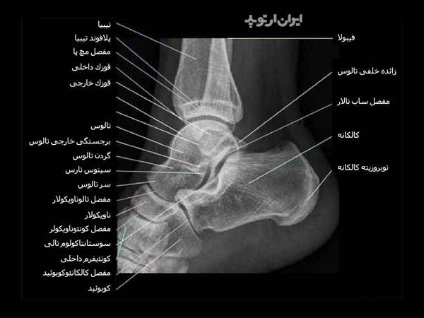 رادیوگرافی نیمرخ مچ پا