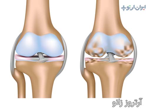 ساییدگی زانو چیست و چه علائمی دارد و چگونه درمان میشود