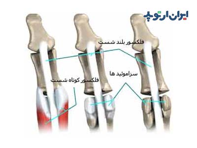 استخوان سزاموئید در پا