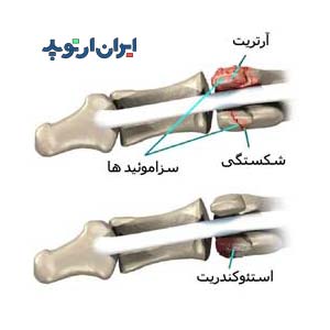 خرابی استخوان سزاموئید پا