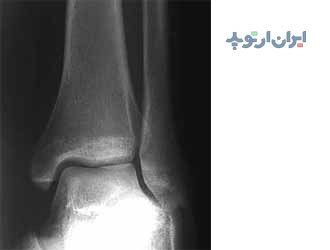 تصویر رادیوگرافی یک مچ پای طبیعی