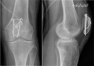  جراحی شکستگی کشکک زانو و فیکس کردن قطعات شکسته شده کشکک با پین و وایر