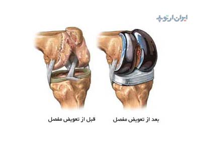 مراقبت های بعد از تعویض مفصل زانو